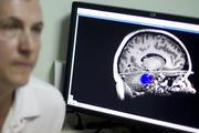 Врачи нашли новое подтверждение заразности болезни Альцгеймера