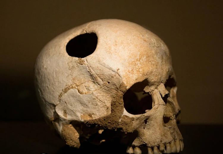 Загадка черепа с дыркой, непредусмотренной нормальной анатомией  