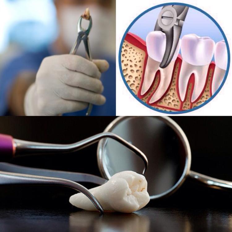  Стоматолог Наталья Кадькалова: как понять, нужно ли удалять зуб