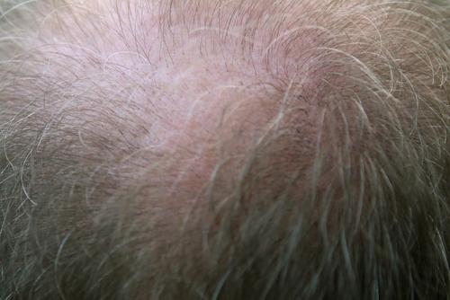 Трихологи Гаджигороева и Ткачев сообщили, что выпадение волос у мужчин не всегда приводит к лысине