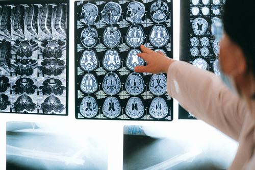Российские ученые сообщили о неврологических аномалиях мозга у переболевших коронавирусом 