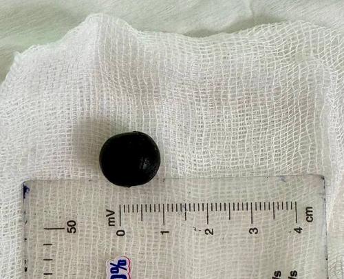 Хирурги извлекли из головы петербуржца саморез и резиновый мячик