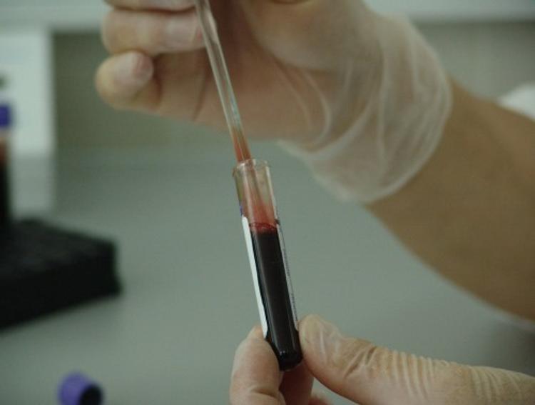 Ученые научились определять шизофреников по анализу крови