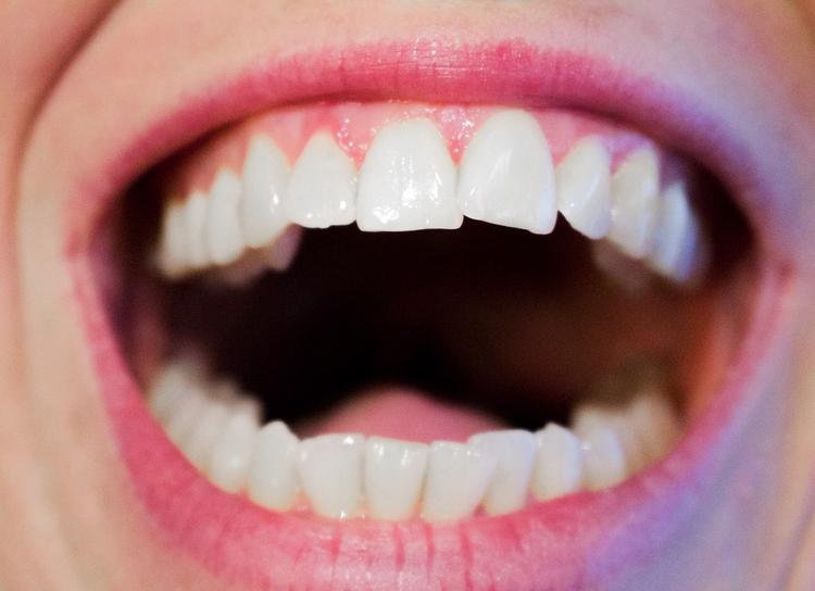 Эксперты назвали самый доступный способ отбеливания зубов в домашних условиях