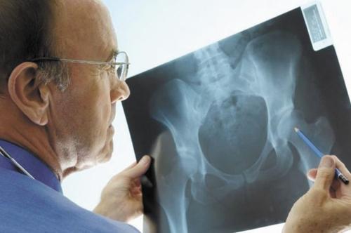 В России от остеопороза страдают 14 млн человек