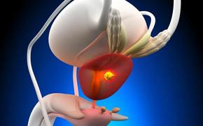 Удар грома - аденома