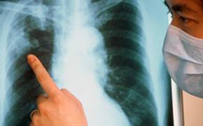 Диагноз "туберкулез" подтвердился у 1 студента техникума Батайска