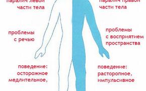 Диагностика инсульта стала для москвичей бесплатной