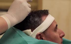 Южноуральцам с алопецией поможет операция по пересадке волос