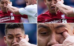 Футболисту "Ливерпуля" соперник проткнул глаз во время матча